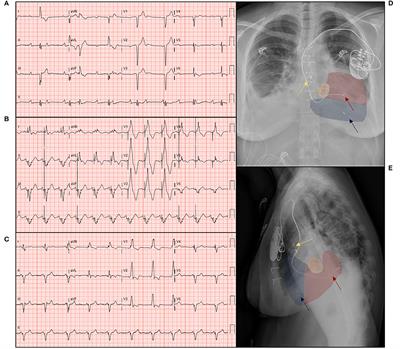 Atrioventricular Block Necessitating Chronic Ventricular Pacing After Tricuspid Valve Surgery in Patients With a Systemic Right Ventricle: Long-Term Follow-Up